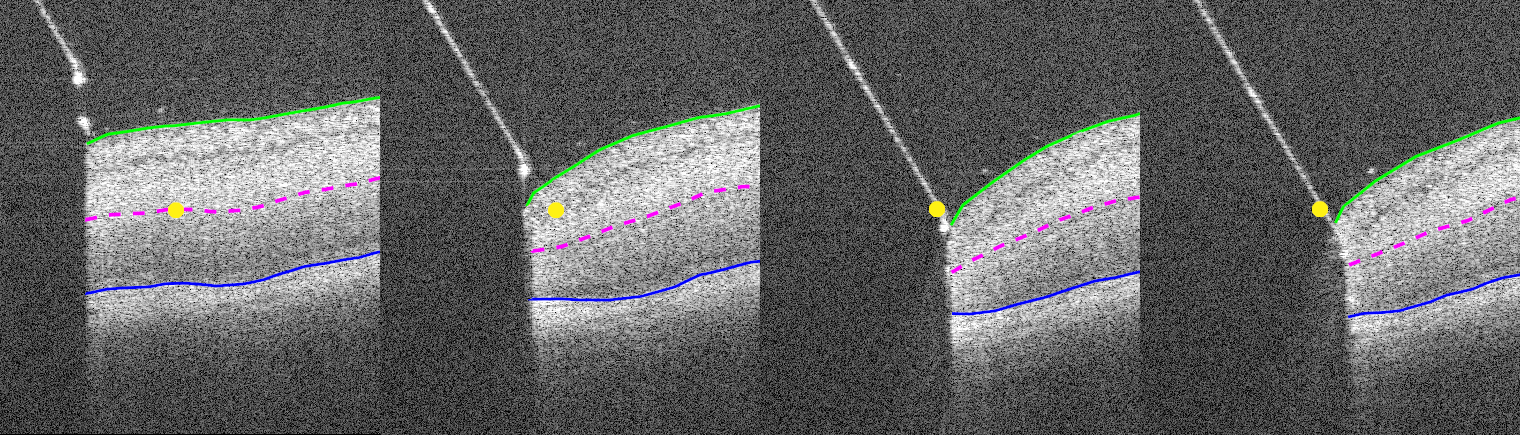 Needle insertion with fixed target point